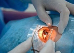 лечение катаракты специфика